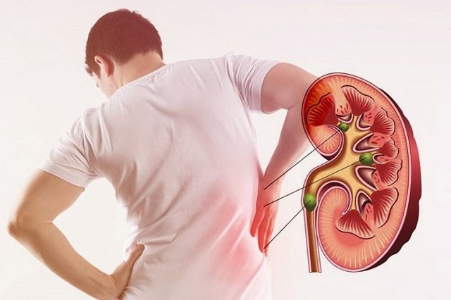 Kidney Stone Doctor In Harda