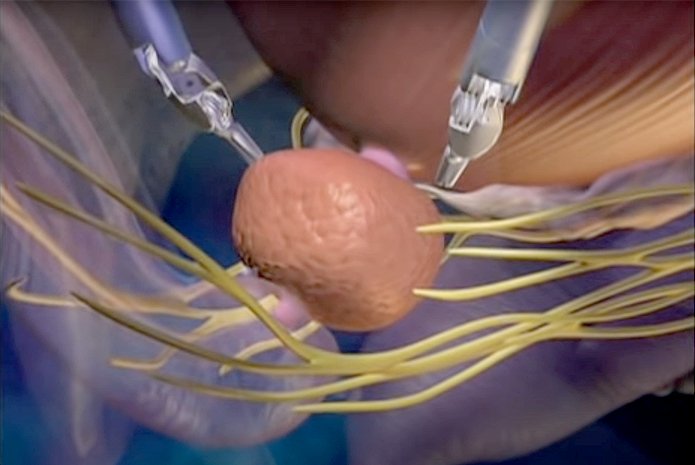 Prostate Surgeon In Itarsi